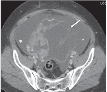 Figure 2. Reduction in dimensions of the cystic mass, parietal discontinuity (ar- (ar-row) and voluminous ascites that was not identified at the previous study  (aster-isks) performed eight days ago.