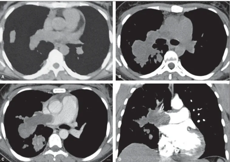 Figure 1. Axial chest computed tomography (A) demonstrating hypodense mass occupying the lumen of the right pulmonary artery