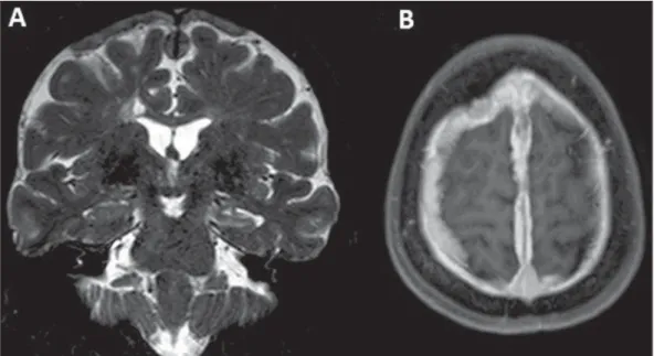 Figure 1. A: Coronal magnetic resonance imaging – T2-weighted sequence demonstrating diffuse pachymeningeal thickening most prominent at the high convexity and extending bilaterally toward the falx, with predominance of hyposignal in association with reduc