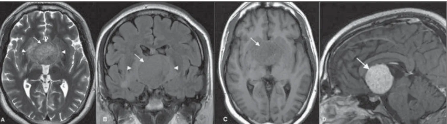 Figure 1. Axial MRI T2-weighted (A) and coronal FLAIR (B) sequences reveal a slightly hyperintense, well-defined hypothalamic/third ventricular tumor (arrows), with perilesional vasogenic edema (arrowheads)