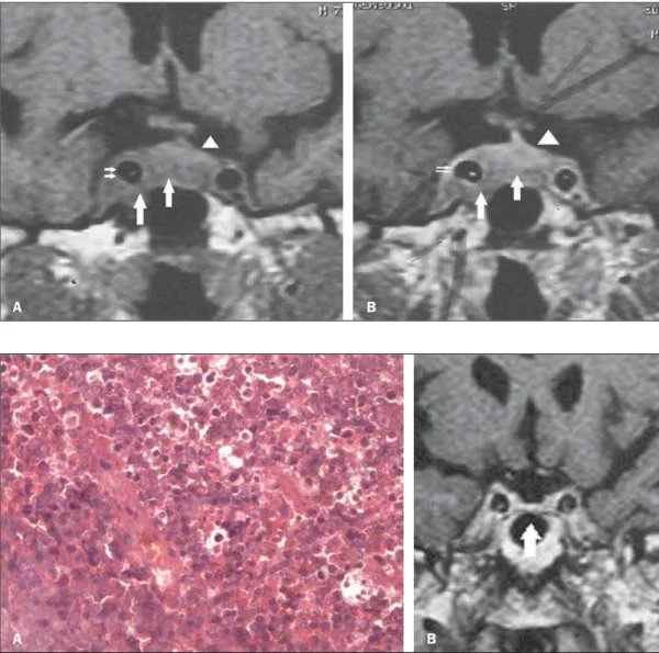 Figure 1. Pre-resection coronal magnetic resonance imaging T1-weighted sequence, before (A) and after (B) contrast agent injection: homogeneous, solid mass (large arrows) showing intermediate signal intensity in the right cavernous sinus,  in-volving the r
