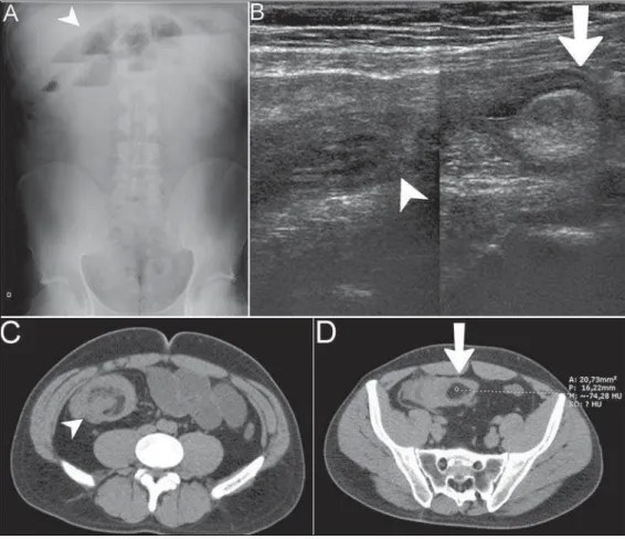 Figure 1. A: Radiographic image dem- dem-onstrating small bowel loops distension with fluid levels (arrowhead)