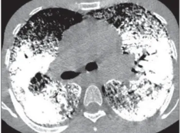Figure 4. HRCT with mediastinal window demonstrating extensive consolida- consolida-tions with calcium density and intermingled air bronchograms bilaterally  distrib-uted throughout the lungs.