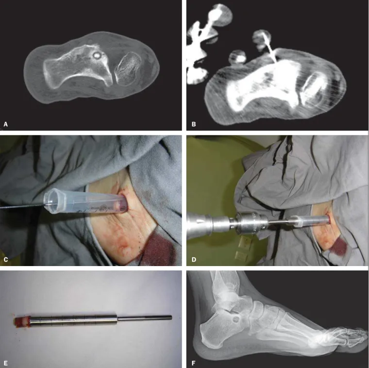 Figure 1. A: A well-defined round nidus is visible in the calcaneus CT image. B: Needle placed into the nidus to precise location of the guide wire