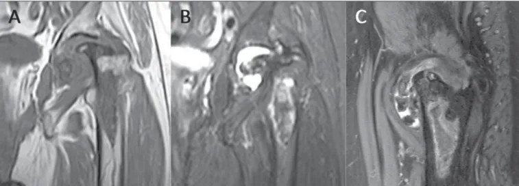 Figure 4. MRI of the same patient on Figure 3. Coronal T1-weighted (A), T2-weighted SPAIR (B) and sagittal T2-weighted SPAIR (C) images of the left hip showing extensive avascular necrosis of the femoral head, with advanced secondary degenerative arthritis