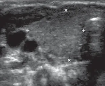 Figure 1. Ultrasonography of the cervical region in an asymptomatic child. Ob- Ob-serve the right thyroid lobe (between markers) with preOb-served echotexture and dimensions.