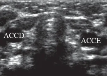 Figure 4. Ultrasonography of cervical region. In this child, the thyroid gland could not be identified