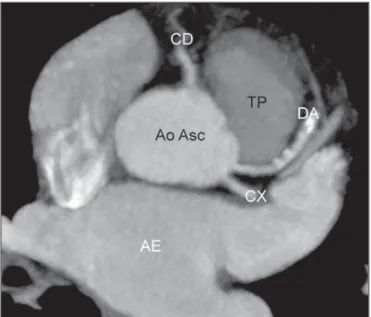 Figure 6. Absence of left coronary trunk. Axial coronary computed tomography angiography and MIP reconstruction showing the origination of the anterior  de-scending artery (DA) and circumflex (CX) artery directly from the left coronary sinus