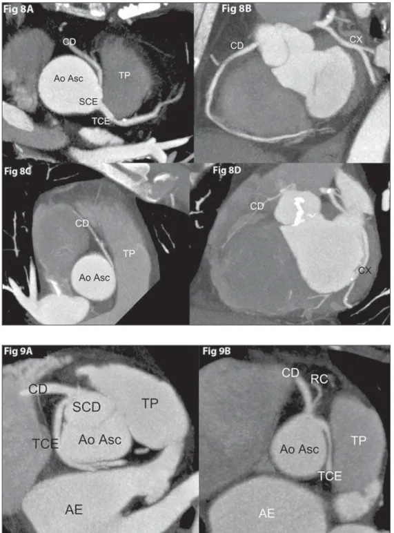 Figure 9. Anomalous origination of left coronary trunk from the right coronary sinus. Fig 9A: Benign course