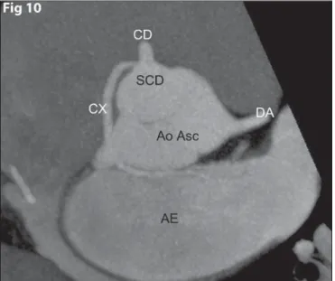 Figure 10. Anomalous origination of the circumflex artery from the right coronary sinus, with benign course