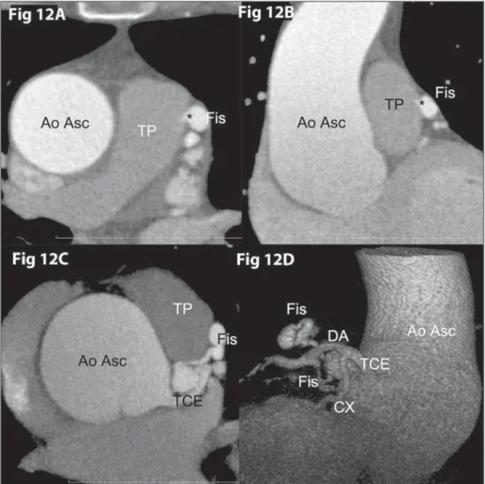 Figure 12. Coronary fistula. Coronary com- com-puted tomography angiography – axial (Fig 11A), oblique coronal (Fig 11B), axial MIP (Fig 11C) and volumetric rendering  demon-strating a tortuous coronary fistula (* Fis), communicating the anterior descendin