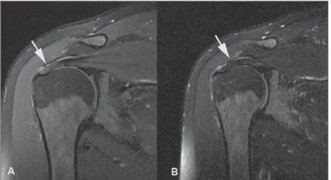 Figure 5. Magic angle and rotator cuff. Increased signal in the supraspinatus tendon at short TE sequence.