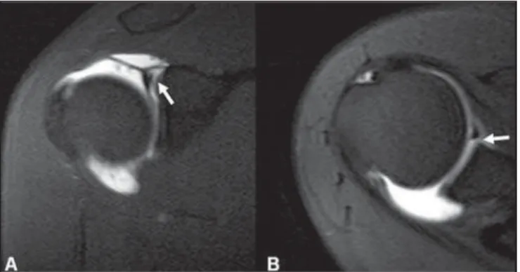 Figure 10. Coronal MR arthrography T1-weighted sequence showing a normal sulcus in the region of the biceps-labral complex (arrow), which is typically parallel to the glenoid (A)