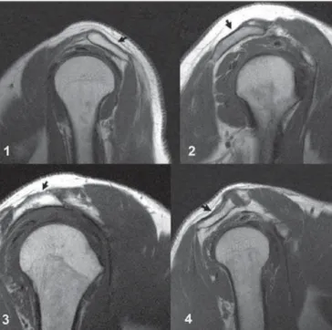 Figure 12. Exaggerated internal rotation on the image A, simulating subscapu- subscapu-laris tendon thickening (short arrow)