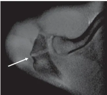 Figure 17. Tubercle of Ossaki. Area of focal subchondral bone thickening with thinned overlying cartilage (arrows).