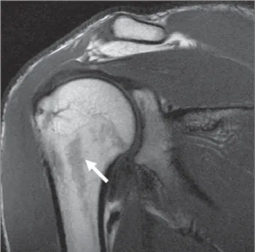 Figure 18. Normal bone marrow striations.