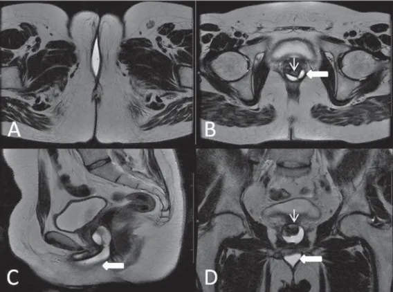 Figure 18. Surgical evaluation for male- male-to-female sex reassignment. Axial (A,B) sagittal (C) and coronal (D) MRI  T2-weighted sequences demonstrate  neo-vagina (bold arrows) and the remains of the corpora cavernosa and of the corpus spongiosum and ur
