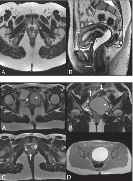 Figure 2. Uterus didelphys, longitudinal and transverse vaginal septa. MRI  T2-weighted (A,B,C) and T1-T2-weighted (D) sequences demonstrating longitudinal septum (thin arrow) dividing the vagina into two parallel cavities