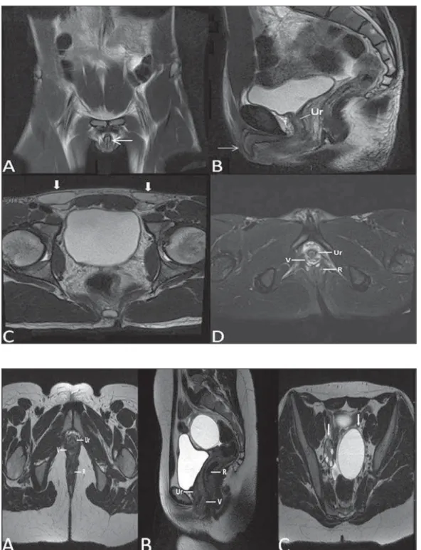 Figure 6. Mayer-Rokitansky-Kuster- Mayer-Rokitansky-Kuster-Hauser syndrome (complete  presen-tation)