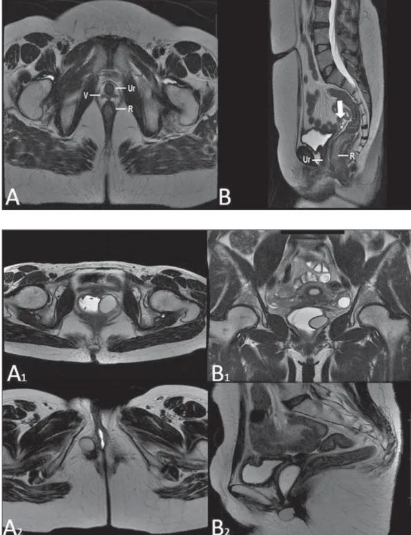 Figure 8. Gartner duct cyst – axial (A 1 ) and sagittal (B 1 ) MRI T2-weighted sequences  demon-strating a cyst located in the left lateral vaginal wall, above the level of the pubic symphysis