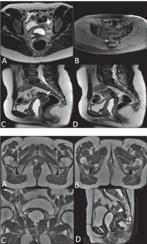 Figure 11. Multiplanar MRI T1-weighted (B) and T2- T2-weighted (A,C,D) sequences of the pelvis  demonstrat-ing the presence of a focus of endometriosis with low signal intensity in the vaginal dome (bold arrows), with signs of local tissue retraction and e