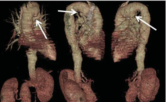 Figure 4. Right and left, anteroposterior and oblique multiplanar reconstructions, utilizing the volume rendering technique, demonstrating focal dilatation of the inferior wall of the aortic arch (arrows).