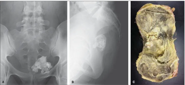 Figure 1. Frontal (A) and lateral (B) radiographic image of the pelvis showing a large calcified mass with multiple toothlike calcifications, indicative of a typical mature teratoma