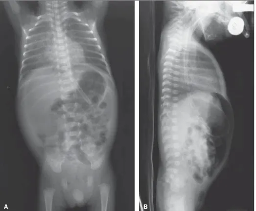 Figura 1. A: Radiografia de tórax e abdome em posição supina com raios verticais demonstra hipertransparência da cavidade abdominal, por acúmulo de ar livre