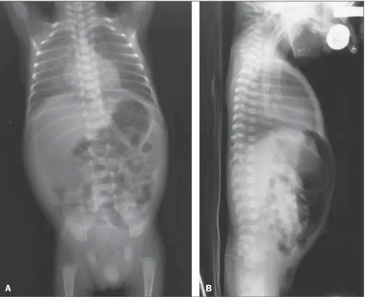 Figure 1. A: Chest and abdominal radiography – Image acquired with the patients in supine position, with vertical x-rays, demonstrating hypertransparent abdominal cavity due to accumulation of free air