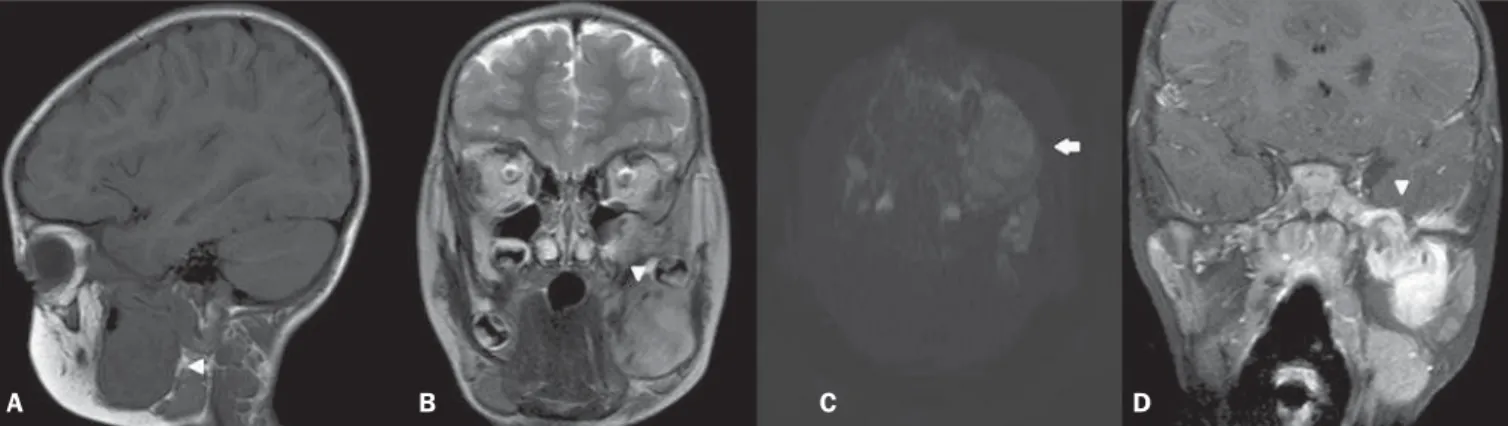 Figure 1. A: Sagittal, T1-weighted image showing lesion with hyposignal affecting the mandible (arrowhead)