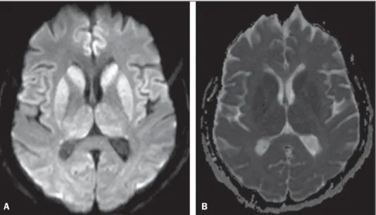 Figura 1. A: Imagem axial de ressonância magnética do crânio demonstrando focos de hipersinal na sequência ponderada em difusão nas cabeças dos núcleos caudados, putâmens, tálamos e giros occipitotemporais mediais