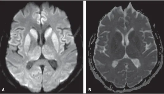 Figure 1. A: Axial magnetic resonance imaging of the skull demonstrating foci of hypersignal at diffusion-weighted sequences in the heads of the caudate nuclei, putamina, thalami and medial occipitotemporal gyri