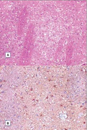Figure 2. A: Section of the caudate nucleus demonstrating abundant small, optically empty vacuoles in the gray matter