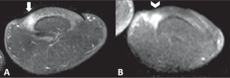 Figure 2. Histological section – hematoxylin-eosin staining showing typical appearance of a glomus  tu-mor.