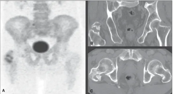 Figure 1.  18 F-NaF PET image (A) shows osteogenic reaction in the region of the major trochanter and intertrochanteric sulcus of the right femur, suggesting secondary involvement by the underlying disease