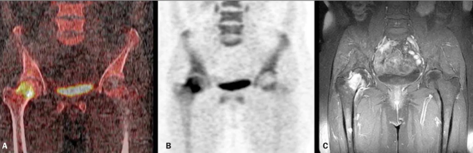 Figure 2. Coronal fusion PET/CT (A) and PET (B) with  18 F-NaF show osteogenic reaction at right femoral head and neck, suspicious for bone involvement secondary to the underlying disease