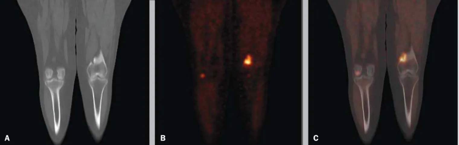 Figure 4. Coronal CT (A), PET (B) and  18 F-NaF PET/CT fusion (C) images show osteogenic reaction in the distal metaphyseal region of the left femur, suggestive of metastatic bone infiltration originating from melanoma