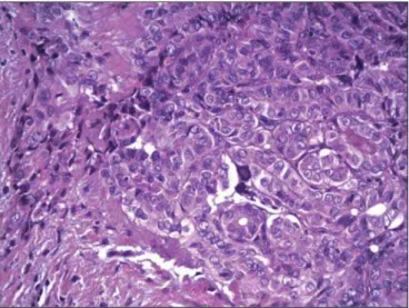 Figure 2. Circumscribed neoplastic papilliferous thyroid carcinoma. Presence of inflammatory cells, especially lymphocytes (lymphocytic thyroiditis).