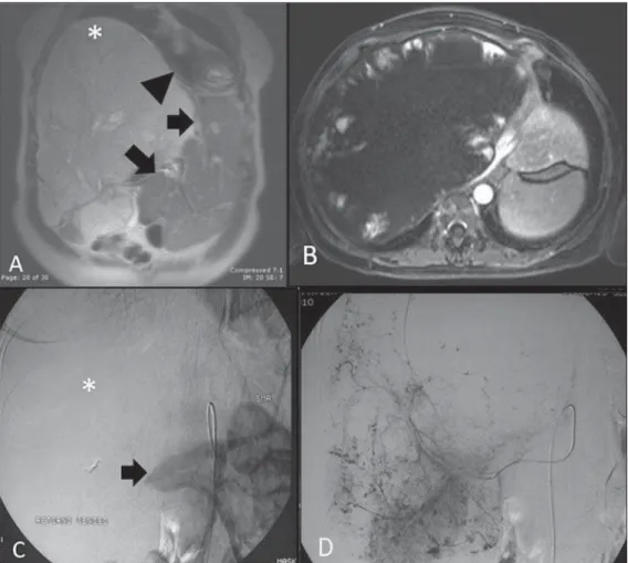Figure 1. A: Coronal, T2-weighted MR image showing extension of the giant hemangioma into the thorax (asterisk) and displacement of the heart  (arrow-head) as well as of normal liver  paren-chyma (arrows)