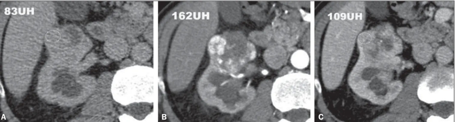 Figure 2. Clear cell RCC variant. CT, pre-contrast (A), corticomedullary (B) and nephrographic (C) phases