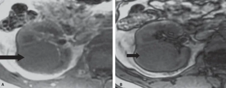 Figure 3. Clear cell RCC variant. MRI with the chemical shift imaging technique. In phase (A) and out of phase (B) images showing expansile, solid lesion in the right kidney (arrows) presenting with subtle signal loss in the out of phase sequence, that is 