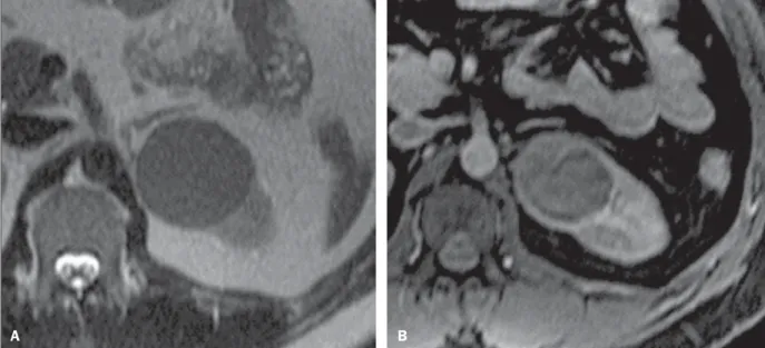 Figure 4. Papillary RCC variant. A: MRI, axial, T2-weighted image showing expansile, homogeneous lesion with intense hyposignal