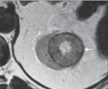 Figure 6. Chromophobe RCC. MRI, axial T2-weighted image identifying expansile, well delimited lesion in left kidney, with intermediate signal intensity, a distinct pseudocapsule (arrow) and a central scar area.