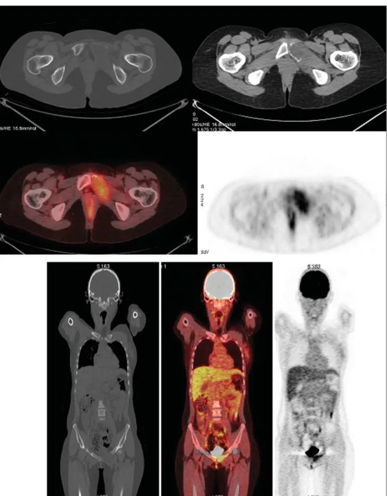 Figure 1. PET/CT image of a 13-year-old female patient diagnosed with Ewing’s sarcoma