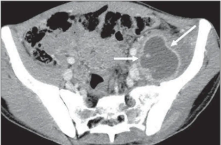Figure 19. Prostatic tuberculosis. Hypoattenuating nodular lesion with periph- periph-eral enhancement compatible with abscess.