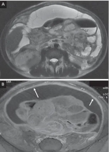 Figure 1. Wet peritonitis in a 27-year-old, female patient. Axial MRI T2-weighted sequence (A) demonstrates large ascites with multiple fine septa