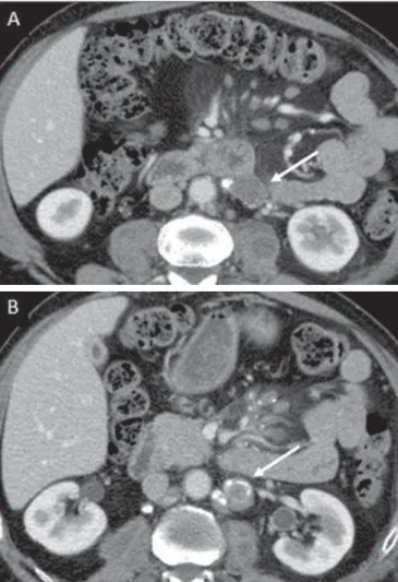 Figure 3. Tuberculous lymph node disease in a 54-year-old, male patient. Pres- Pres-ence of multiple enlarged lymph nodes in the mesenteric root and periaortic  re-gion