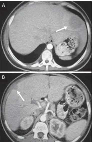 Figure 8. Macronodular hepatic tuberculosis. Contrast-enhanced abdominal CT demonstrating the presence of hypovascular nodules in the left (A) and right (B) lobes.