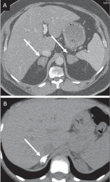 Figure 11. Adrenal tuberculosis. A: CT shows hyperplasia of both adrenal glands.