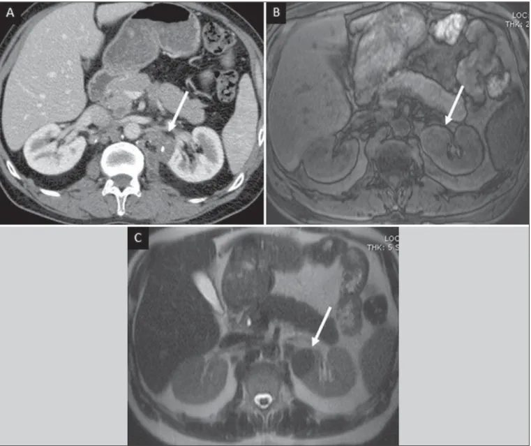 Figure 12. Tuberculoma in left kidney. CT shows hypovascular, partially calcified nodule (A)